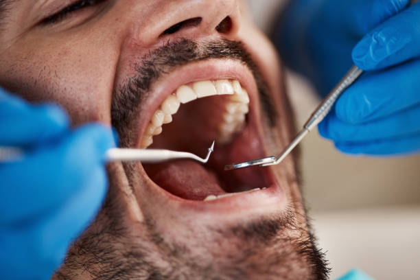 Best Root Canal Treatment  in Burlington, WA